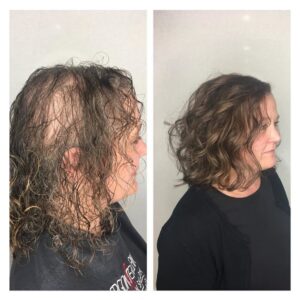 Woman with severe thinning hair on the side of her head.